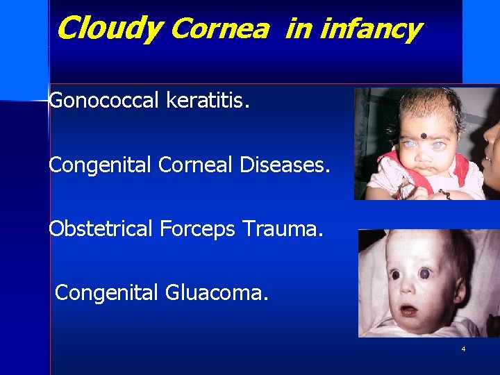 Cloudy Cornea in infancy Gonococcal keratitis. Congenital Corneal Diseases. Obstetrical Forceps Trauma. Congenital Gluacoma.