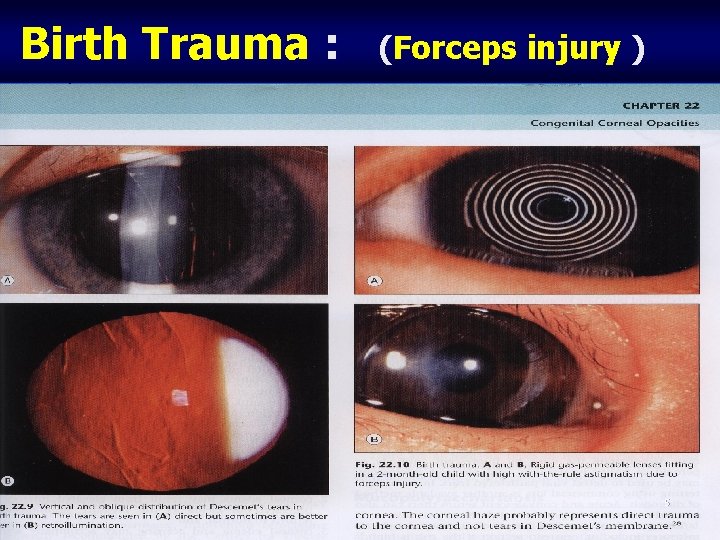 Birth Trauma : (Forceps injury ) 5 