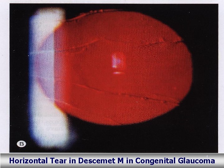 6 Horizontal Tear in Descemet M in Congenital Glaucoma 