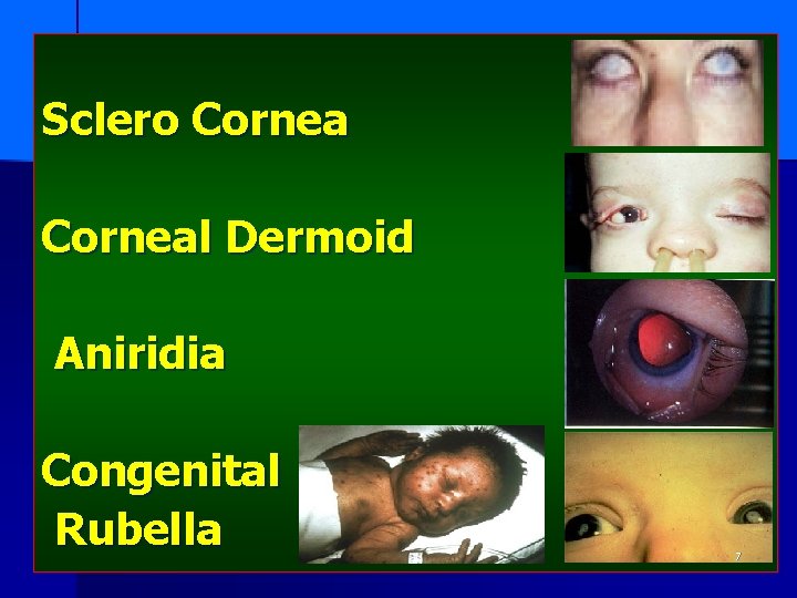 Sclero Corneal Dermoid Aniridia Congenital Rubella 7 