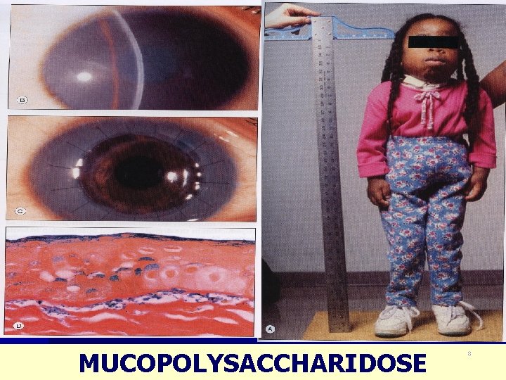 MUCOPOLYSACCHARIDOSE 8 