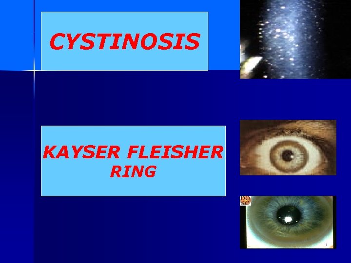 CYSTINOSIS KAYSER FLEISHER RING 9 