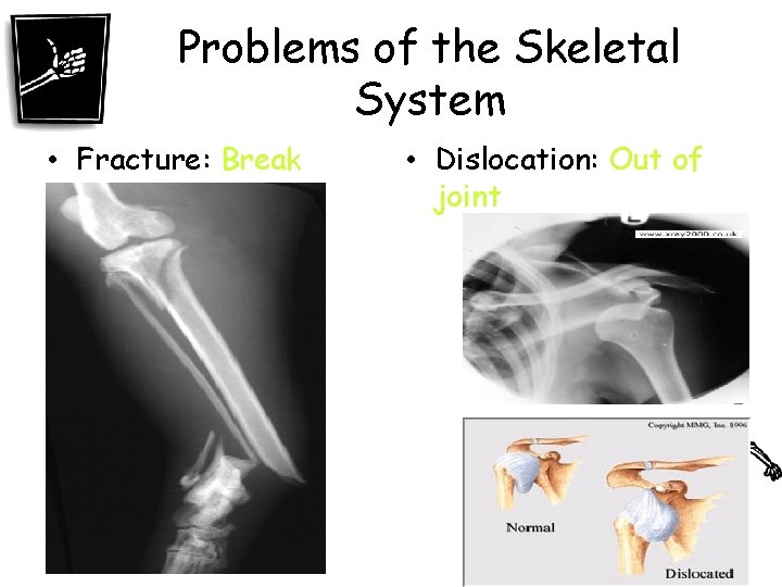 Problems of the Skeletal System • Fracture: Break • Dislocation: Out of joint 
