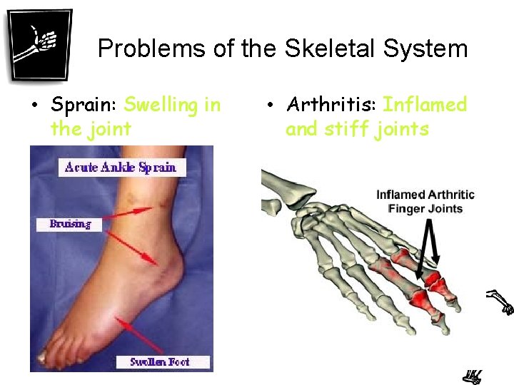 Problems of the Skeletal System • Sprain: Swelling in the joint • Arthritis: Inflamed