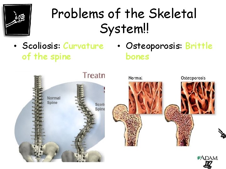 Problems of the Skeletal System!! • Scoliosis: Curvature of the spine • Osteoporosis: Brittle