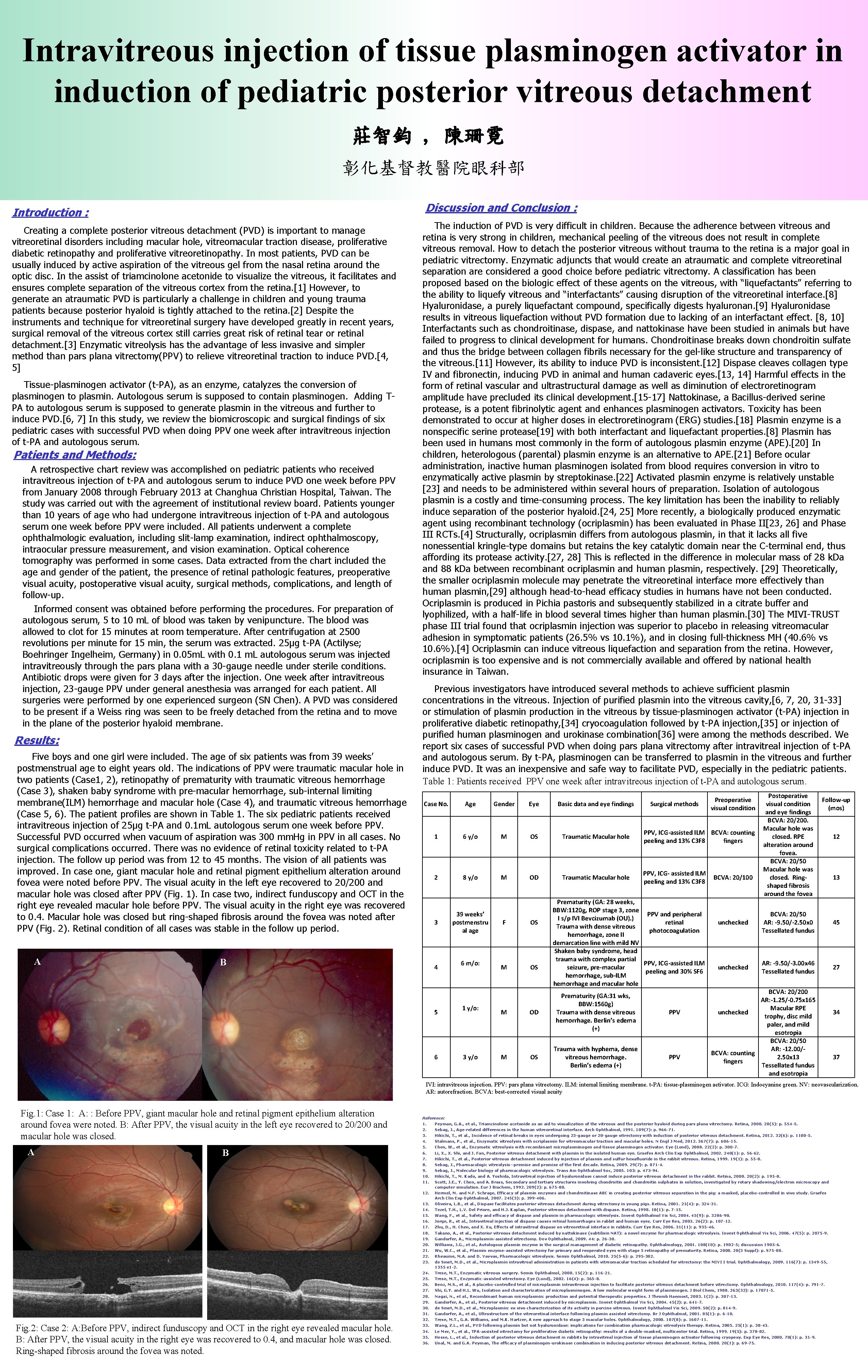 Intravitreous injection of tissue plasminogen activator in induction of pediatric posterior vitreous detachment 莊智鈞