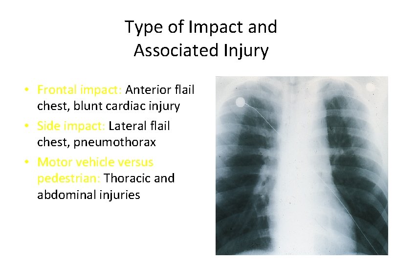 Type of Impact and Associated Injury • Frontal impact: Anterior flail chest, blunt cardiac