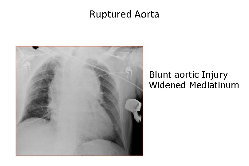 Ruptured Aorta Blunt aortic Injury Widened Mediatinum 