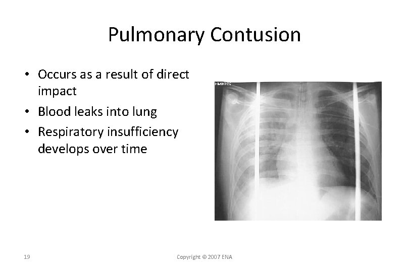 Pulmonary Contusion • Occurs as a result of direct impact • Blood leaks into