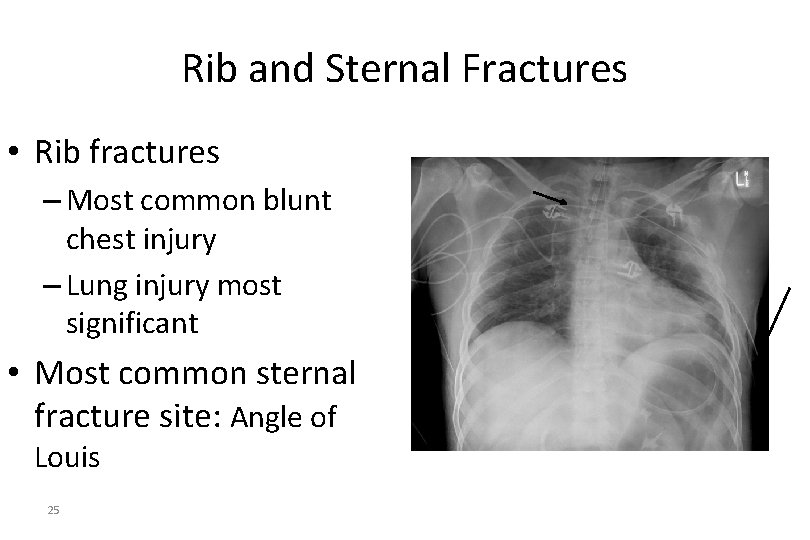 Rib and Sternal Fractures • Rib fractures – Most common blunt chest injury –
