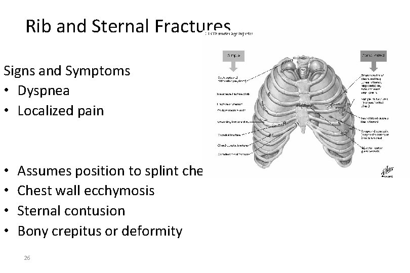 Rib and Sternal Fractures Signs and Symptoms • Dyspnea • Localized pain • •