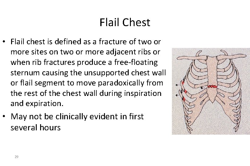 Flail Chest • Flail chest is defined as a fracture of two or more