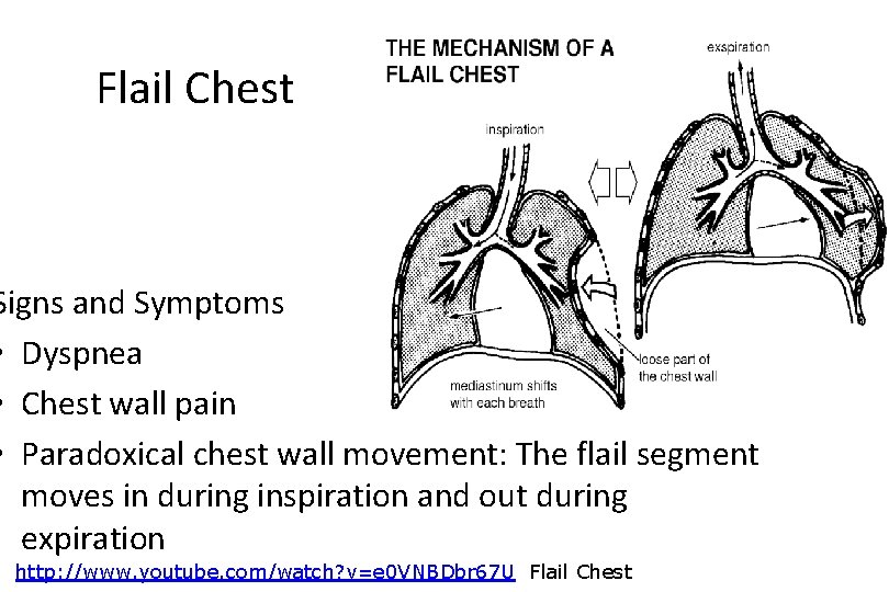 Flail Chest Signs and Symptoms • Dyspnea • Chest wall pain • Paradoxical chest