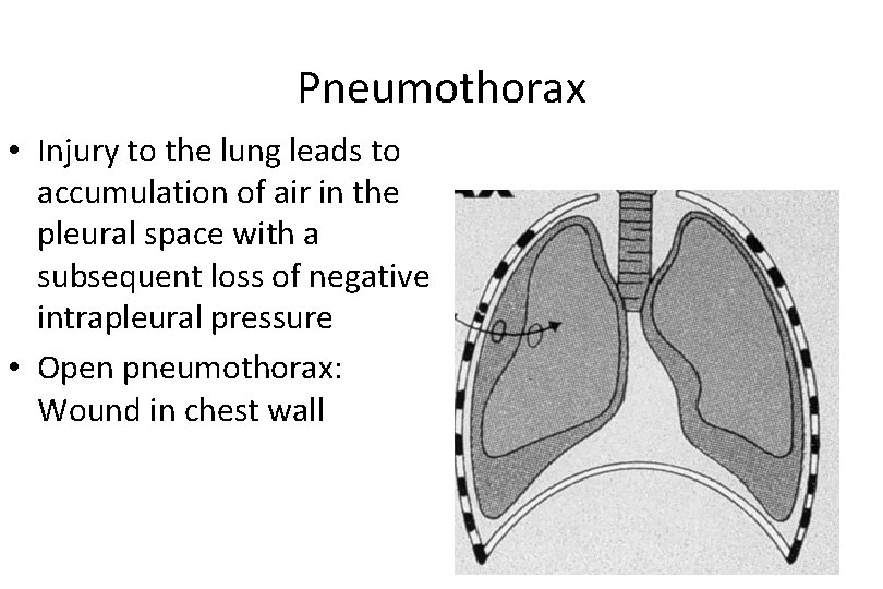 Pneumothorax • Injury to the lung leads to accumulation of air in the pleural