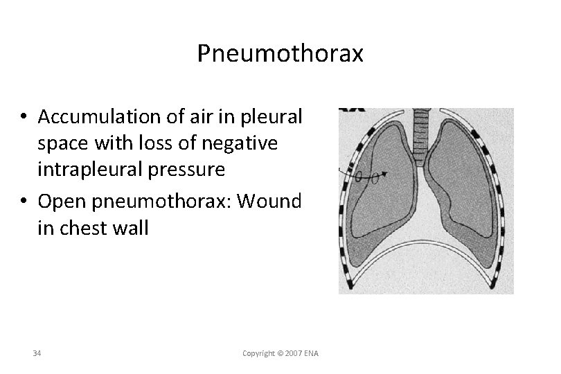 Pneumothorax • Accumulation of air in pleural space with loss of negative intrapleural pressure