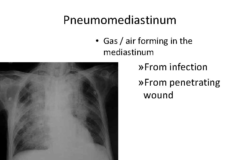 Pneumomediastinum • Gas / air forming in the mediastinum » From infection » From