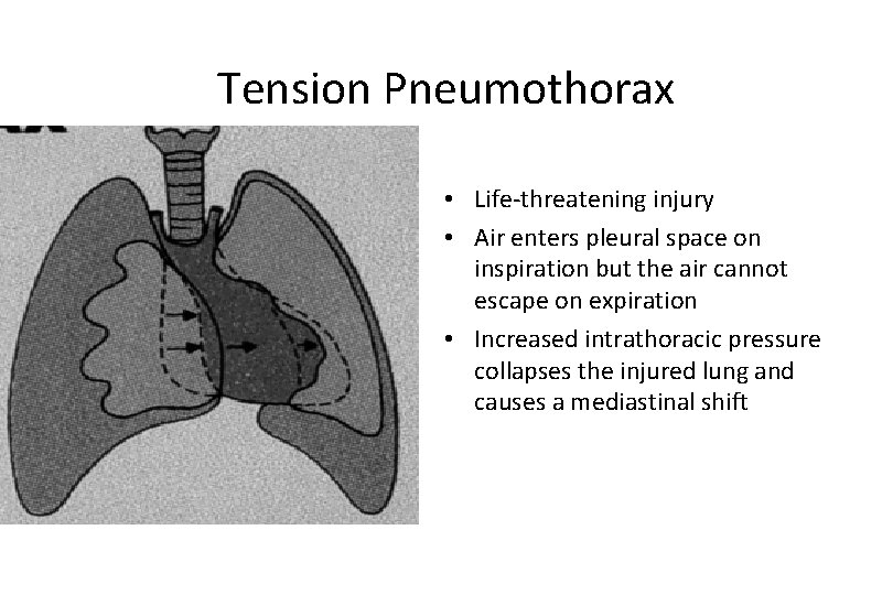Tension Pneumothorax • Life-threatening injury • Air enters pleural space on inspiration but the