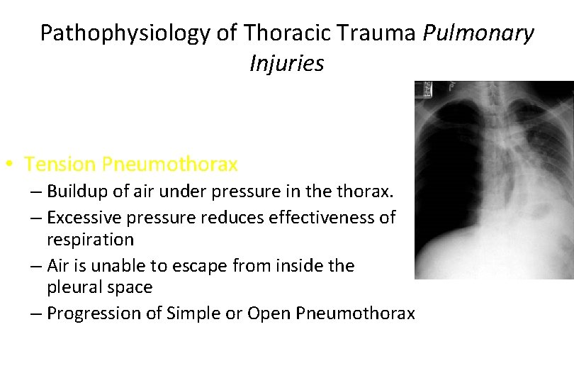 Pathophysiology of Thoracic Trauma Pulmonary Injuries • Tension Pneumothorax – Buildup of air under