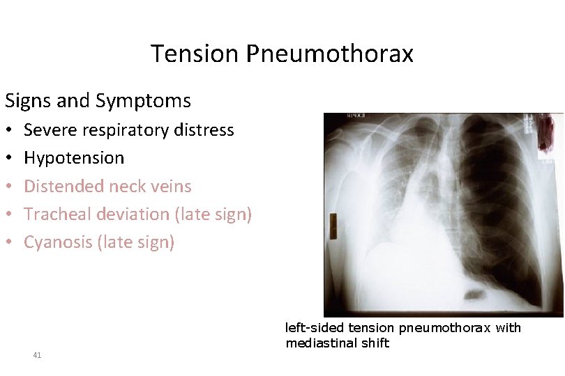Tension Pneumothorax Signs and Symptoms • • • Severe respiratory distress Hypotension Distended neck
