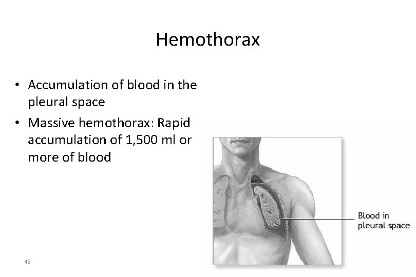 Hemothorax • Accumulation of blood in the pleural space • Massive hemothorax: Rapid accumulation