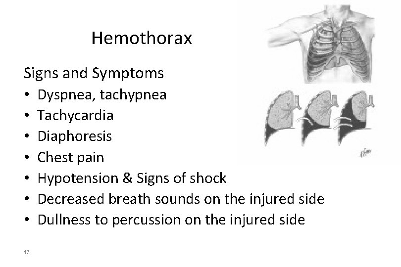Hemothorax Signs and Symptoms • Dyspnea, tachypnea • Tachycardia • Diaphoresis • Chest pain