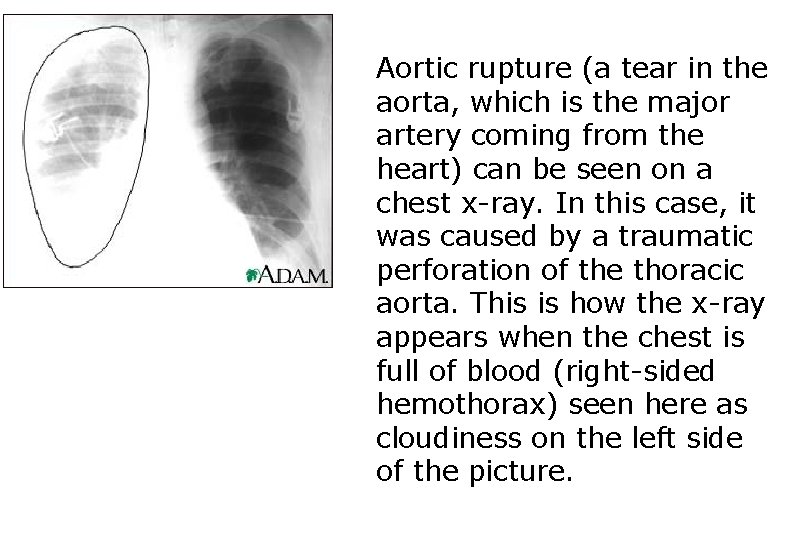 Aortic rupture (a tear in the aorta, which is the major artery coming from