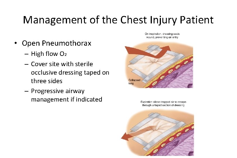 Management of the Chest Injury Patient • Open Pneumothorax – High flow O 2