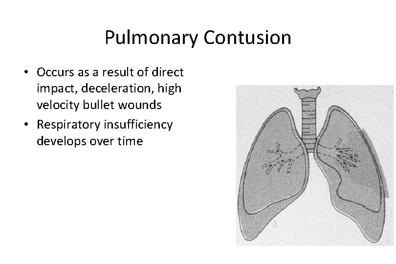 Pulmonary Contusion • Occurs as a result of direct impact, deceleration, high velocity bullet