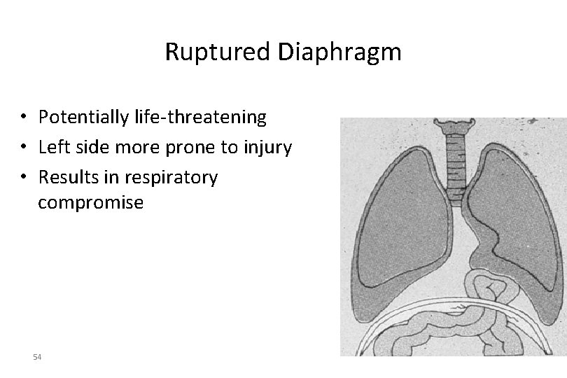 Ruptured Diaphragm • Potentially life-threatening • Left side more prone to injury • Results