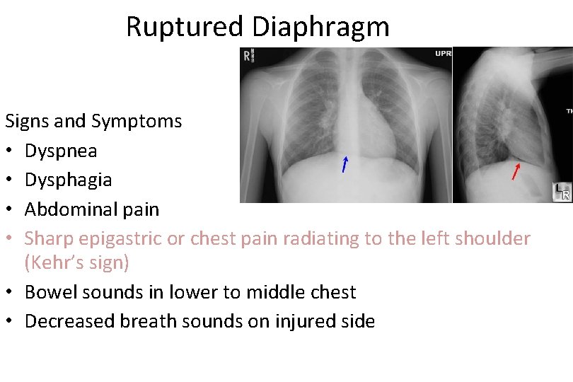 Ruptured Diaphragm Signs and Symptoms • Dyspnea • Dysphagia • Abdominal pain • Sharp