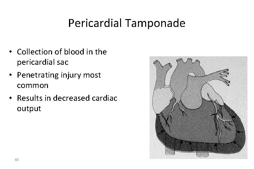 Pericardial Tamponade • Collection of blood in the pericardial sac • Penetrating injury most