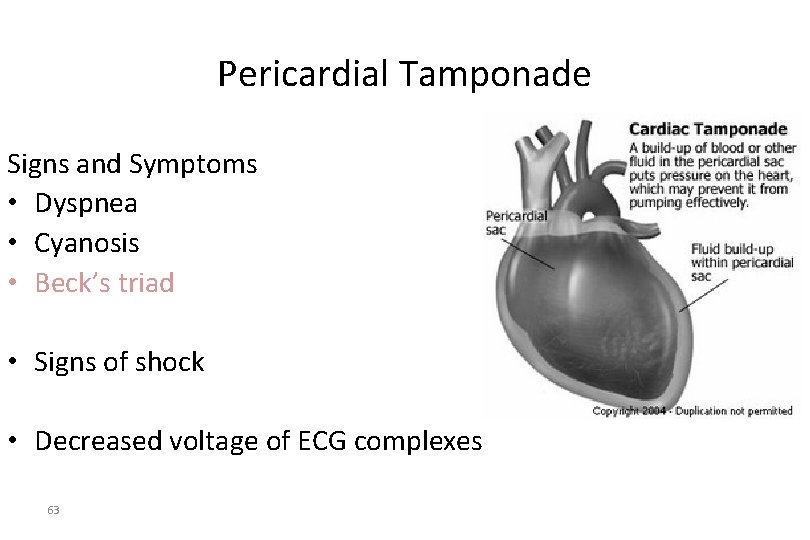 Pericardial Tamponade Signs and Symptoms • Dyspnea • Cyanosis • Beck’s triad • Signs