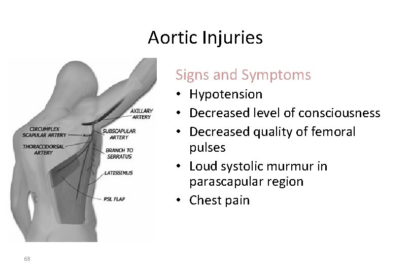 Aortic Injuries Signs and Symptoms • Hypotension • Decreased level of consciousness • Decreased