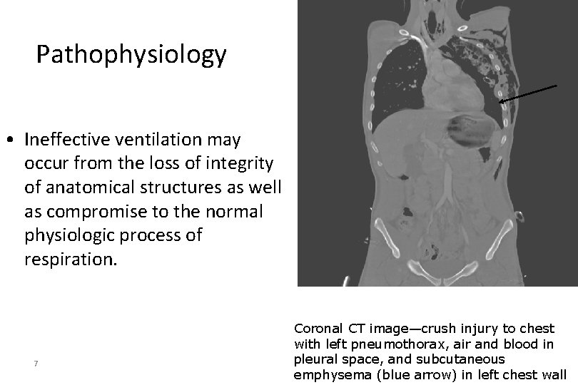 Pathophysiology • Ineffective ventilation may occur from the loss of integrity of anatomical structures