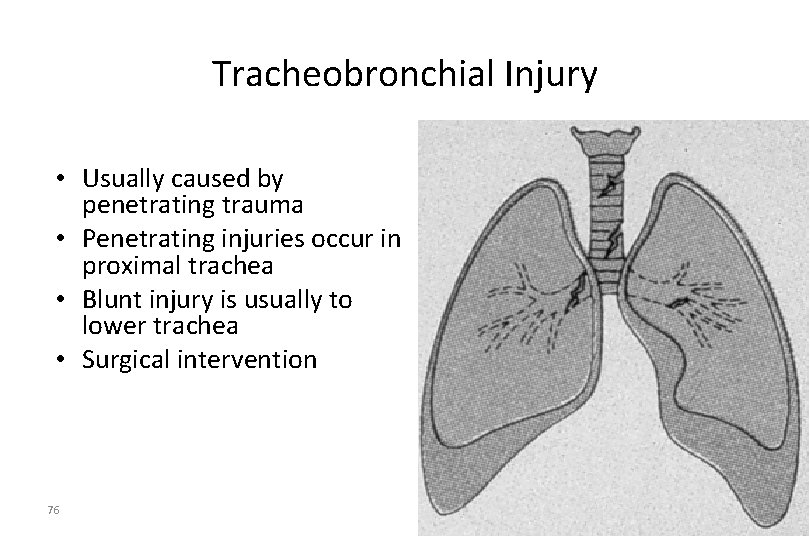 Tracheobronchial Injury • Usually caused by penetrating trauma • Penetrating injuries occur in proximal