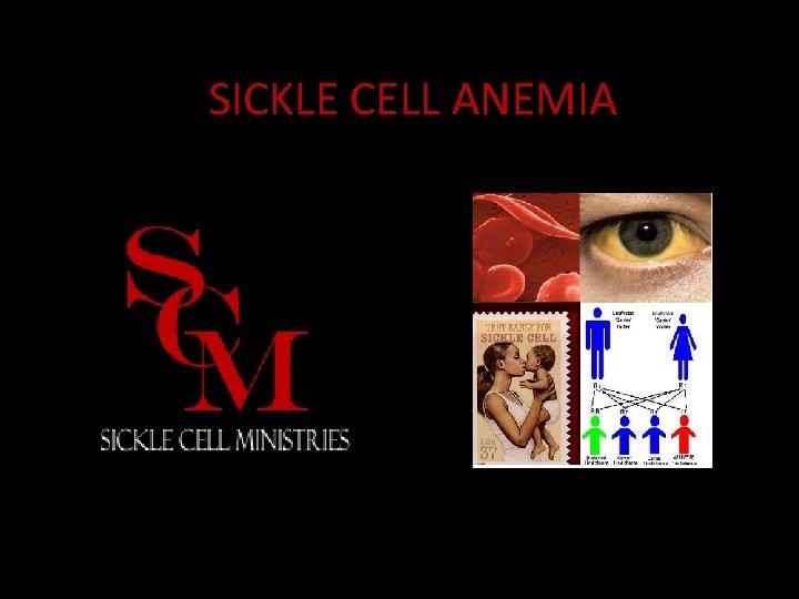 SICKLE CELL ANEMIA 