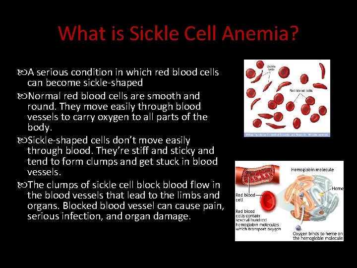 What is Sickle Cell Anemia? A serious condition in which red blood cells can