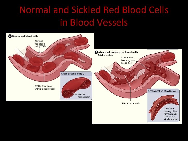 Normal and Sickled Red Blood Cells in Blood Vessels Figure B shows abnormal, sickled