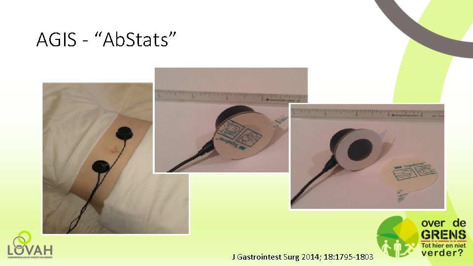 AGIS - “Ab. Stats” J Gastrointest Surg 2014; 18: 1795 -1803 