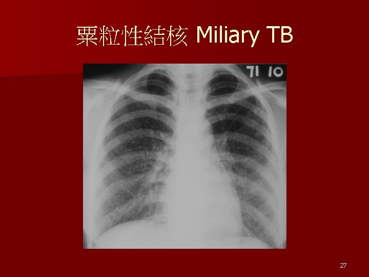 Epidemiology Global Taiwan Pathogenesis and transmission Diagnosis ...