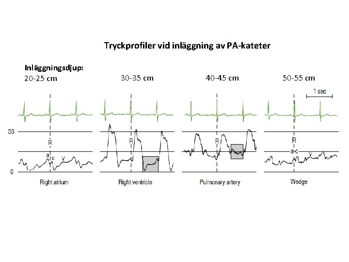 Tryckprofiler vid inläggning av PA-kateter Inläggningsdjup: 20 -25 cm 30 -35 cm 40 -45 Tryckprofiler vid inläggning av PA-kateter Inläggningsdjup: 20 -25 cm 30 -35 cm 40 -45