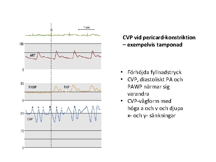 CVP vid pericard-konstriktion – exempelvis tamponad • Förhöjda fyllnadstryck • CVP, diastoliskt PA och CVP vid pericard-konstriktion – exempelvis tamponad • Förhöjda fyllnadstryck • CVP, diastoliskt PA och