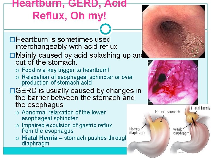 Heartburn, GERD, Acid Reflux, Oh my! �Heartburn is sometimes used interchangeably with acid reflux