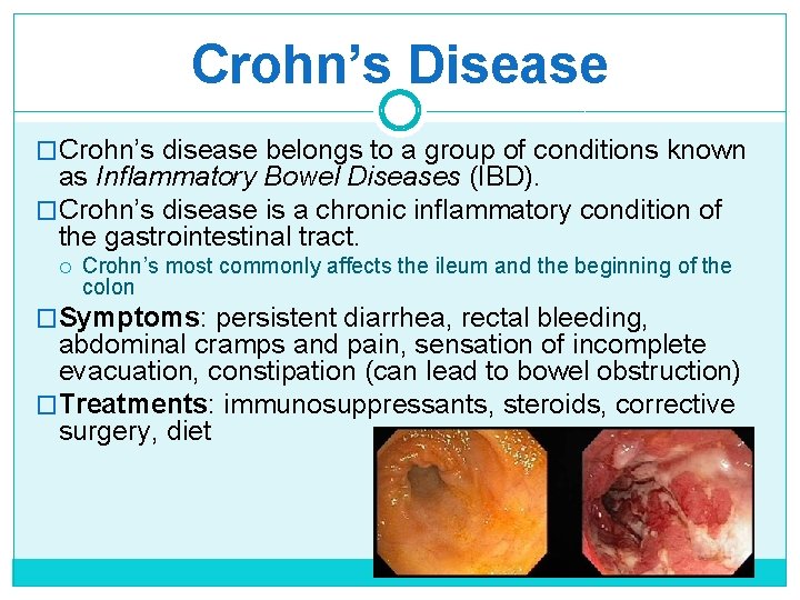 Crohn’s Disease �Crohn’s disease belongs to a group of conditions known as Inflammatory Bowel