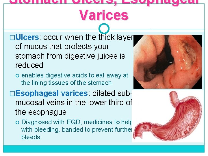 Stomach Ulcers, Esophageal Varices �Ulcers: occur when the thick layer of mucus that protects