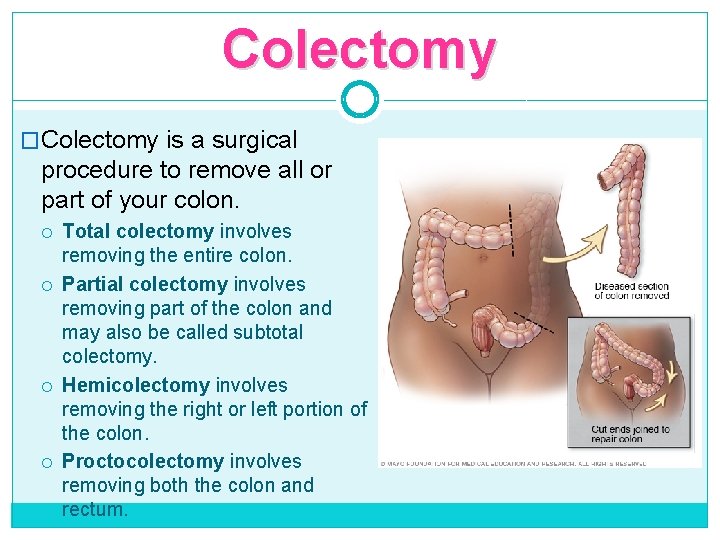 Colectomy �Colectomy is a surgical procedure to remove all or part of your colon.