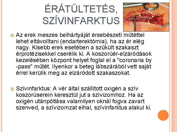 ÉRÁTÜLTETÉS, SZÍVINFARKTUS Az erek meszes belhártyáját érsebészeti műtéttel lehet eltávolítani (endarterektómia), ha az ér