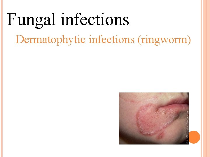 Fungal infections Dermatophytic infections (ringworm) 