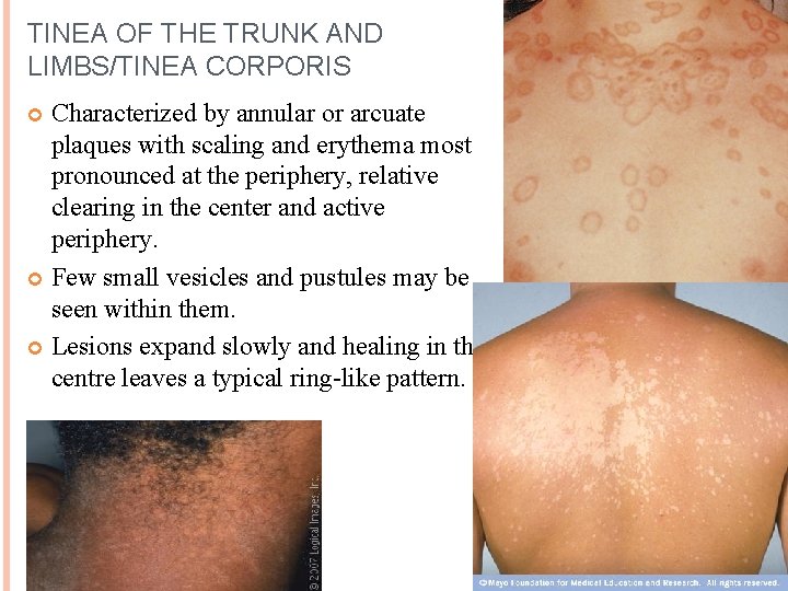 TINEA OF THE TRUNK AND LIMBS/TINEA CORPORIS Characterized by annular or arcuate plaques with