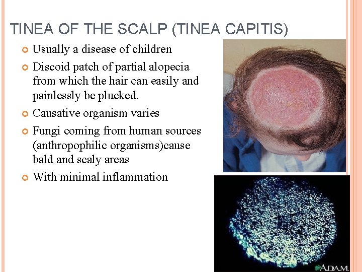 TINEA OF THE SCALP (TINEA CAPITIS) Usually a disease of children Discoid patch of